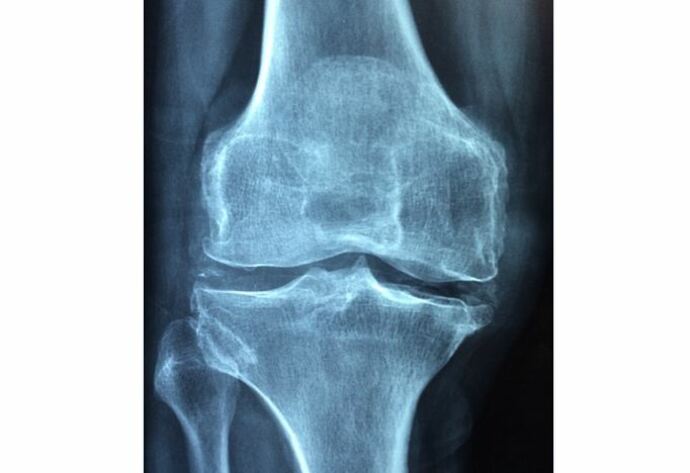 Fracturas de cadera y muñeca, consecuencias más comunes de osteoporosis