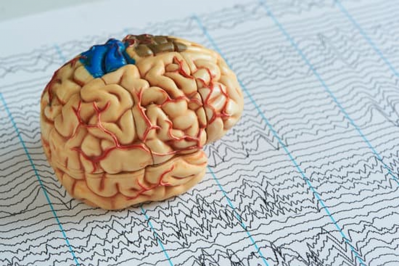 Detección temprana de epilepsia podría reducir daños