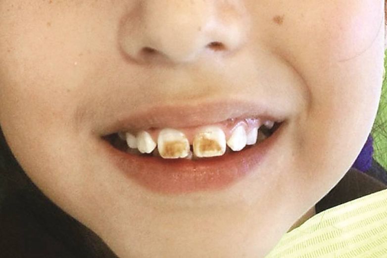 Manchas en los dientes: conoce las causas y el tratamiento 