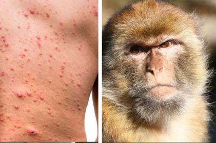 Llega viruela del mono a Juárez; te decimos cómo prevenir el contagio 