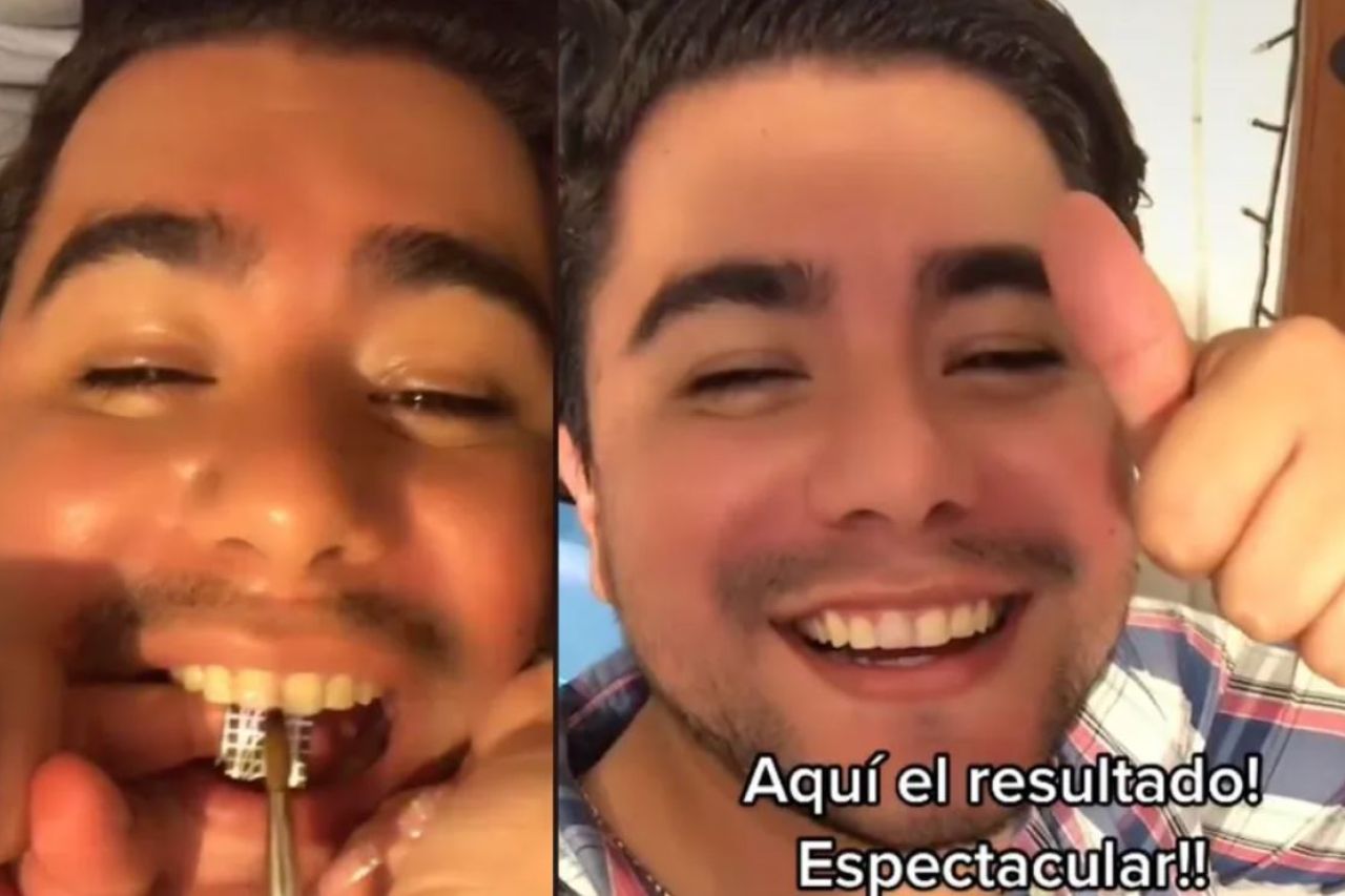 Video: Se quiebra el diente y su novia lo repara con material de uñas