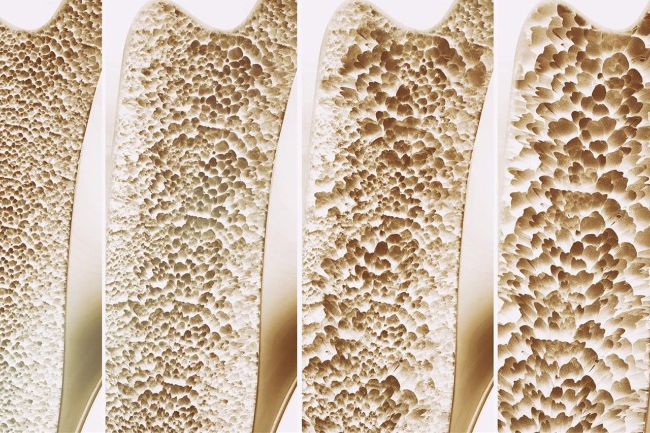 Cuida tus Huesos, cuida tu Futuro: 20 de octubre, Día Mundial de la Osteoporosis