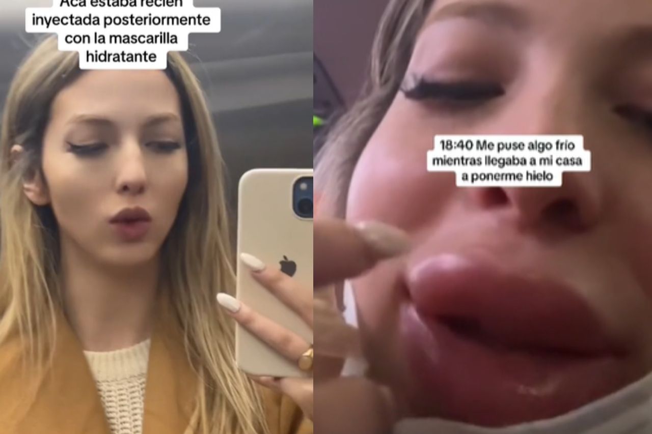 Joven influencer termina desfigurada tras tratamiento de labios