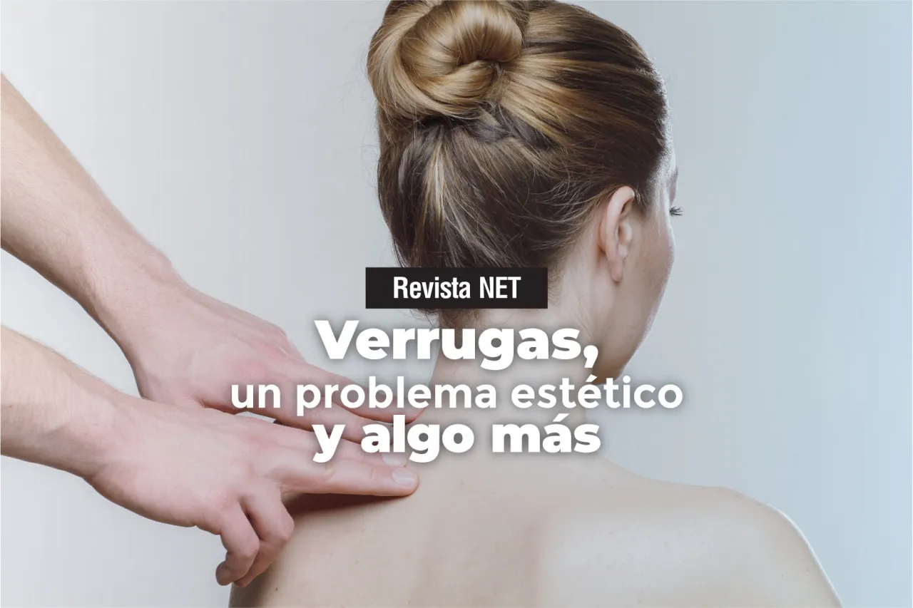 Verrugas, un problema estético y algo más