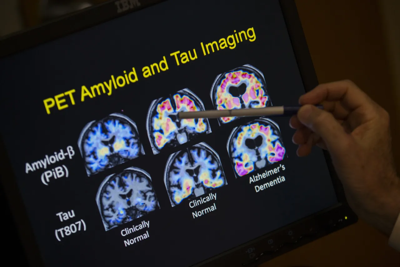 Autoriza RU fármaco para tratar el Alzheimer