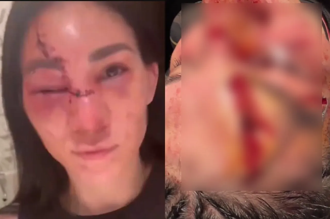 Así quedó el rostro de la mexicana Irene Aldana tras pelea en la UFC