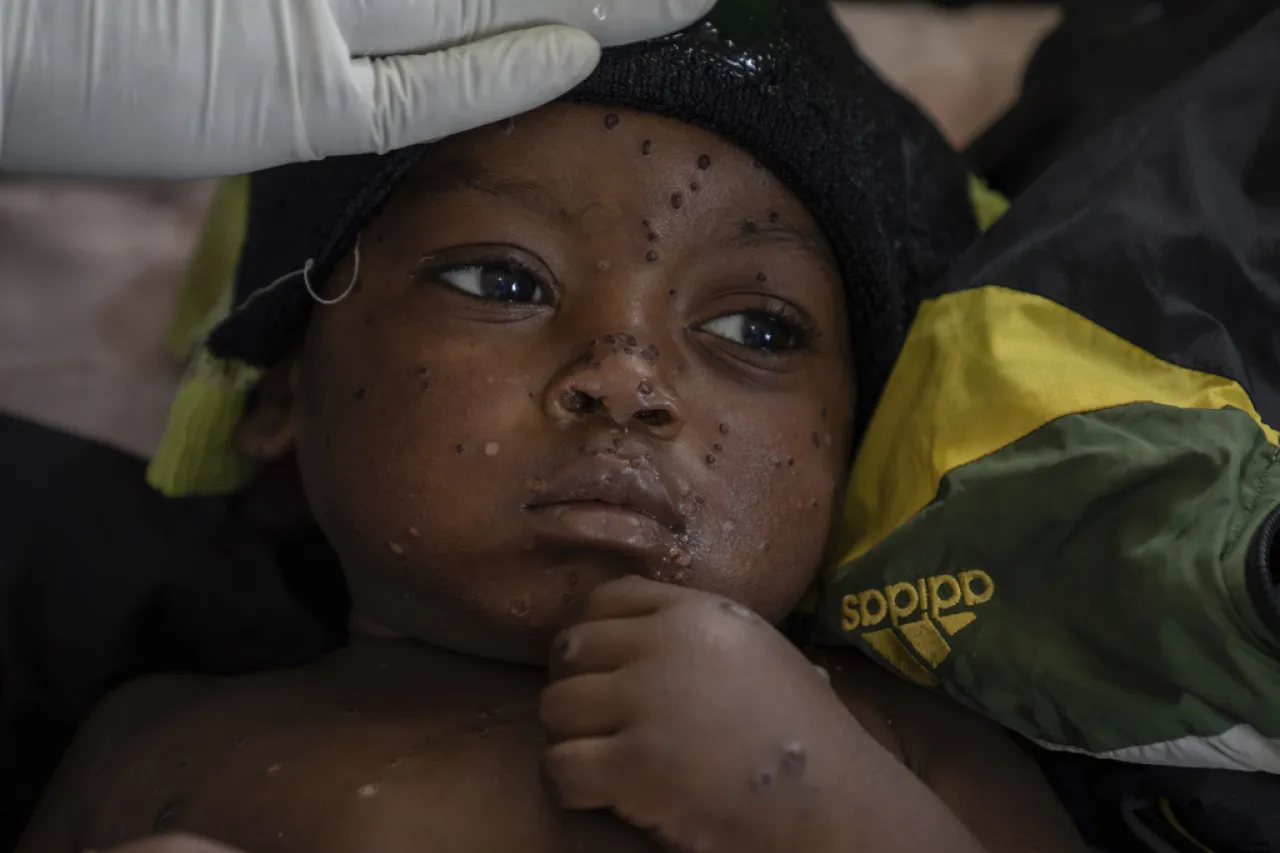 Una ciudad minera en el Congo es foco de la viruela símica