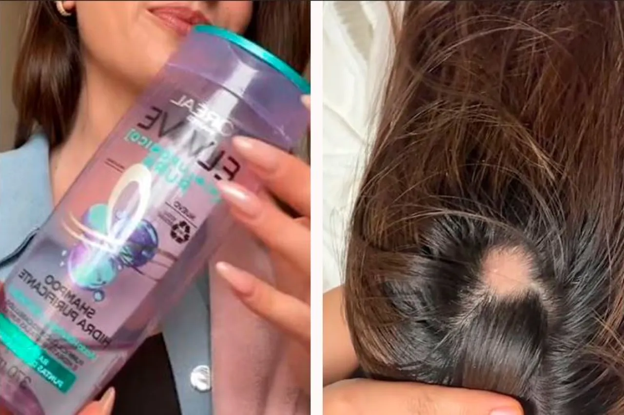 Denuncian que Shampoo de L’Oréal deja calvas a varias