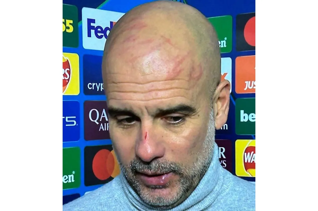 Aparece Pep Guardiola con heridas en la cabeza tras sexto partido sin ganar