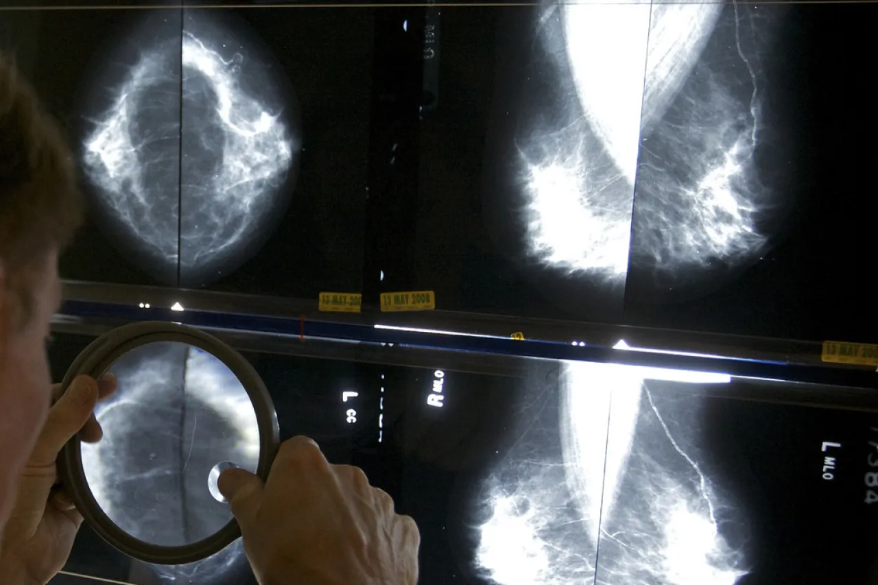 Casos de cáncer avanzado en EU vuelven a niveles prepandémicos