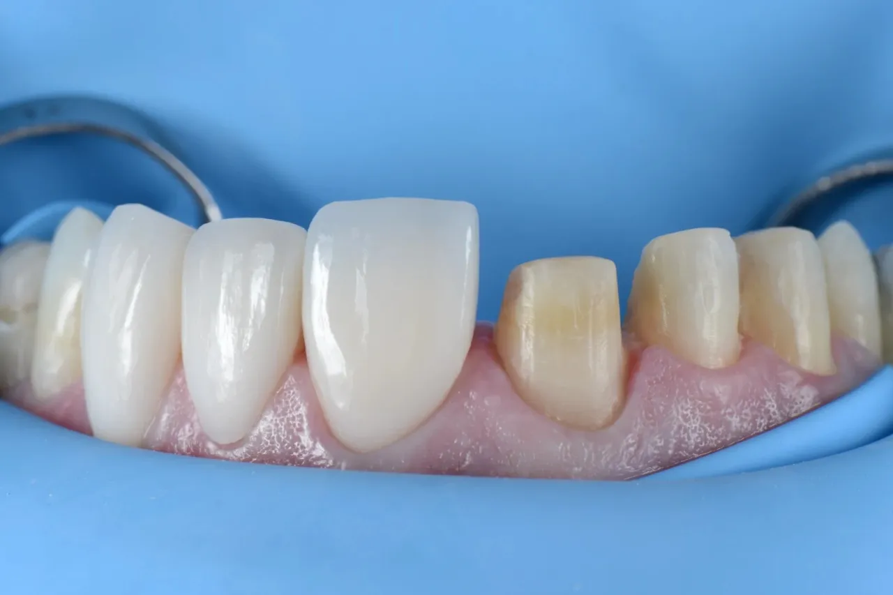 Carillas dentales: La sonrisa 'perfecta' que podría salir muy cara