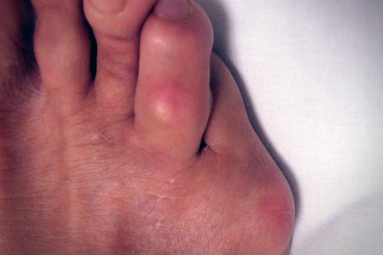 ¿Dedo meñique chueco? Podría tratarse del juanete de sastre