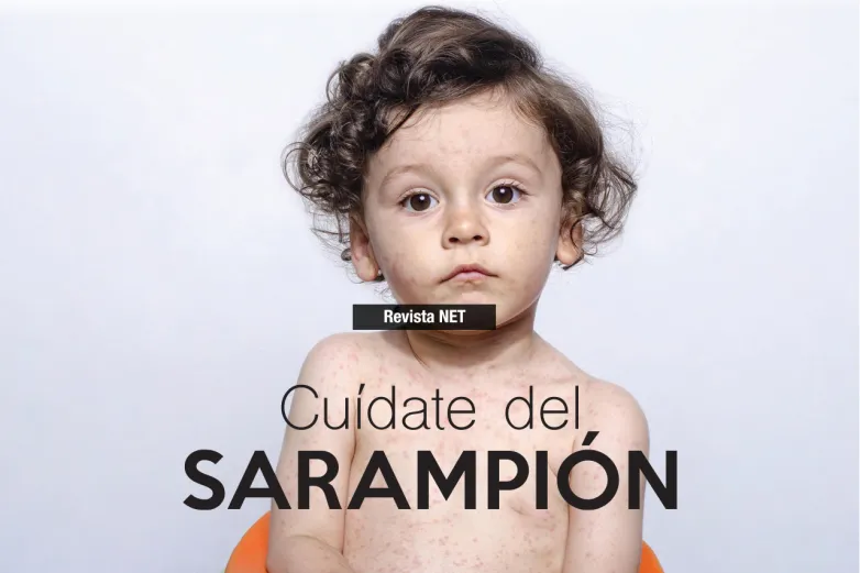 Cuídate del sarampión: síntomas y cómo protegerte de la enfermedad