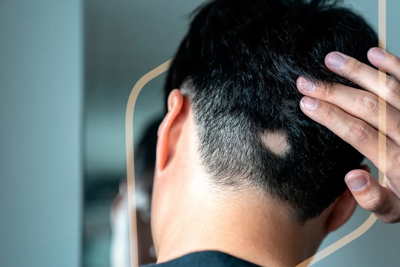 ¿Por qué se cae el cabello? Así afecta la alopecia areata