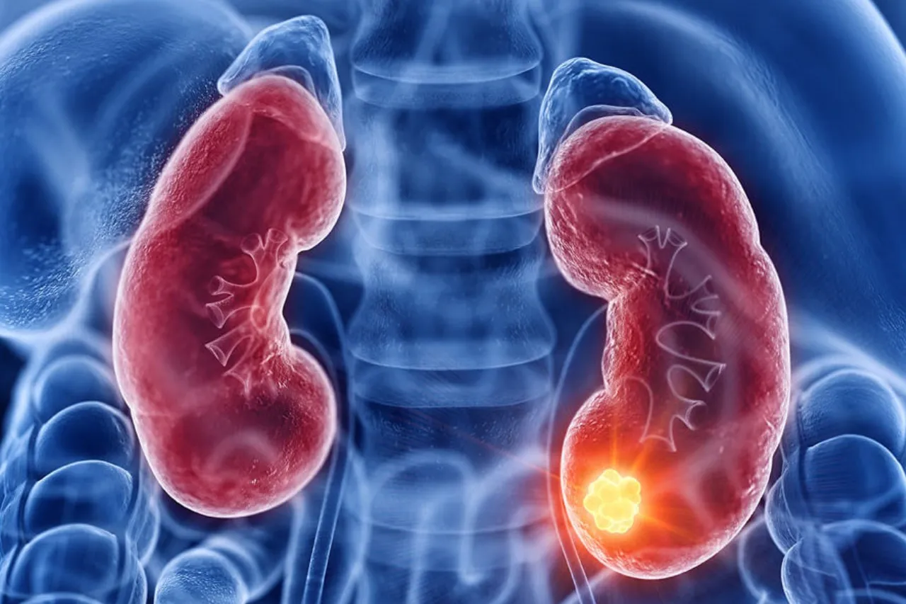 Suma Chihuahua 19 casos de cáncer de riñón en lo que va de 2025