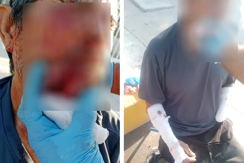 Pitbull ataca a indigente y le destroza el rostro 