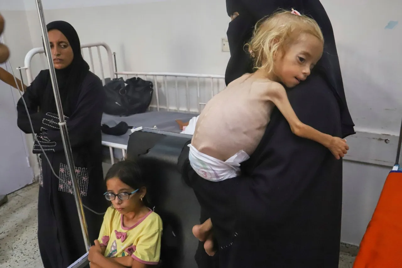 Costillas salientes y extremidades huesudas evidencian desnutrición en Gaza