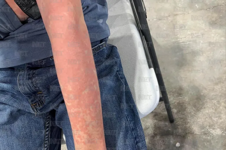 Tiene Juárez 32 casos de sarampión confirmados